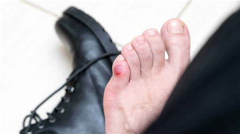 5 Ways To Prevent A Blister On Bottom Of Foot Blister Prevention Rebecca Rushton