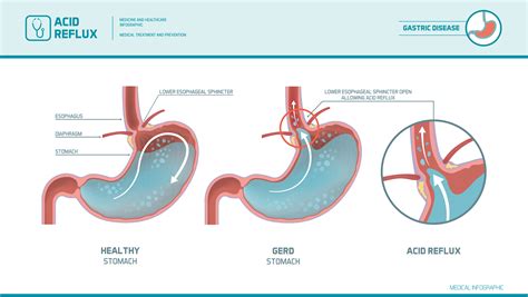 Acid Reflux Heartburn Atlas Treatment Atlas Zone