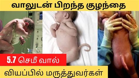 Baby Born With A Tail Medizzy Journal