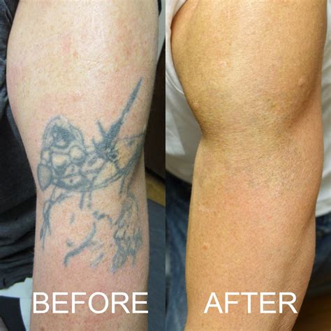 Before After Tattoo Removal Results 2019 Inkaway Laser Tattoo Removal