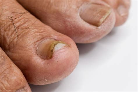 Best Nail Fungus Treatment In Phoenix Arizona Foot Ankle Az Best Nail Fungus Treatment In Phoenix Arizona Foot Ankle Az