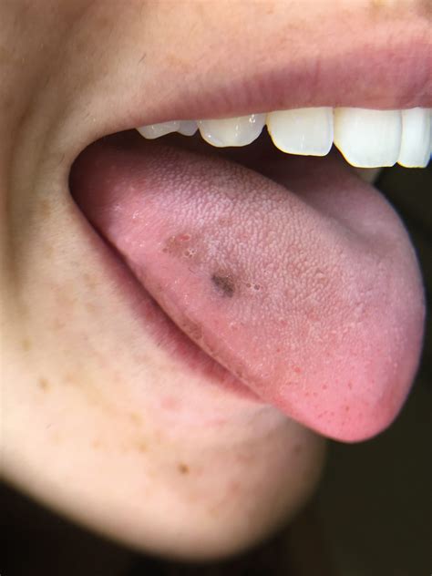 Black Lesions Tongue Hairy Tongue