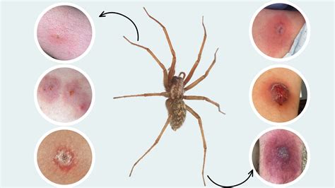 Brown Recluse Spider Everything You Need To Know