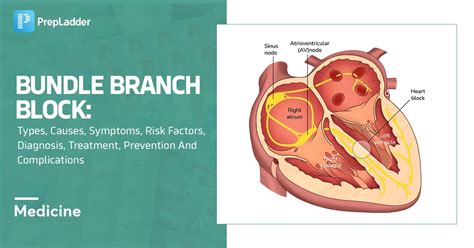 Bundle Branch Block Causes Symptoms Treatment