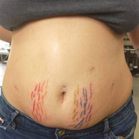 Can You Get A Tattoo Over Stretch Marks Authoritytattoo