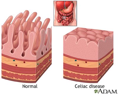 Celiac Disease Medlineplus Medical Encyclopedia Image Celiac Disease Medlineplus Medical Encyclopedia Image