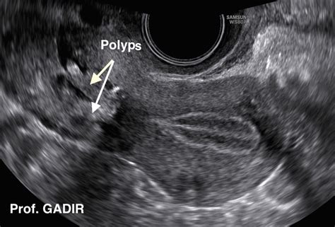 Cervical Polyps Ultrasound