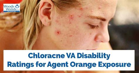 Chloracne Agent Orange