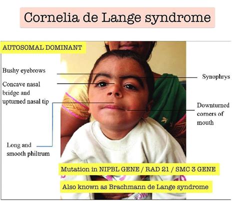 Cornelia De Lange Syndrome Md Searchlight