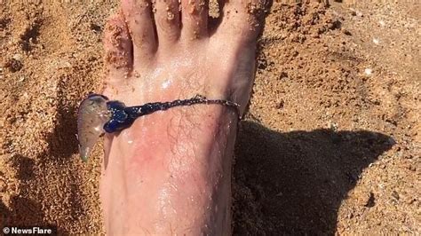 Curious Man Stings Himself On The Foot With A Blue Bottle Twice To Test Curious Man Stings Himself On The Foot With A Blue Bottle Twice To Test