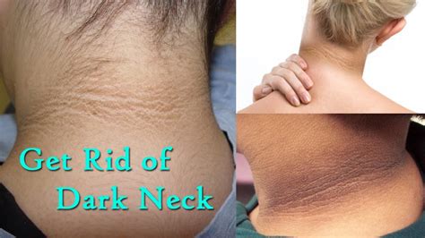 Dark Neck Lines R Beauty