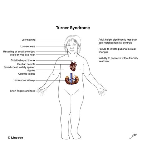 File Turner Syndrome Male 1 Jpg Wikimedia Commons File Turner Syndrome Male 1 Jpg Wikimedia Commons