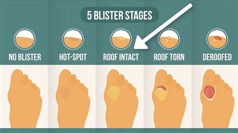 Foot Blister Treatment How To Treat Blisters Properly Blister Prevention Rebecca Rushton