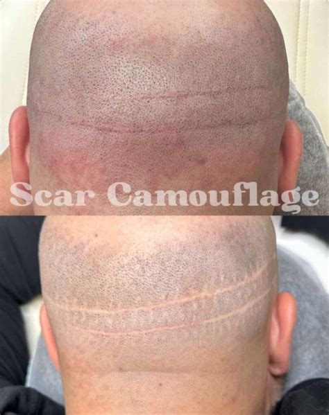 How Smp Conceals Hair Transplant Scars And Restores Confidence Daela
