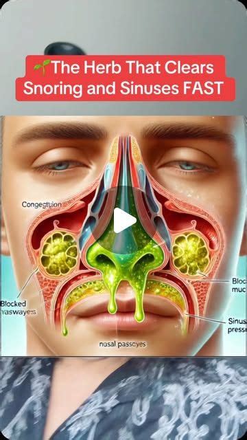How To Clear Sinuses To Stop Snoring Texas Sinus Snoring
