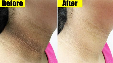 How To Lighten Dark Necks Hyperpigmentation On Neck For A Brighter Skin