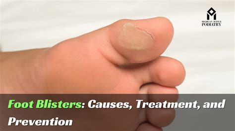 How To Treat Foot Blisters