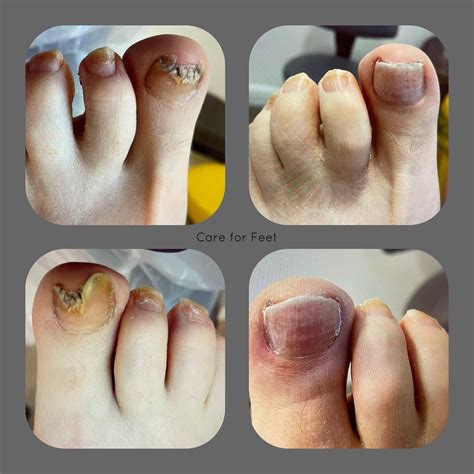How To Treat Fungal Nails Effectively Chapeltown Foot Clinic How To Treat Fungal Nails Effectively Chapeltown Foot Clinic