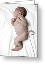 Human Baby With A Tail By Larry Dunstan Science Photo Library