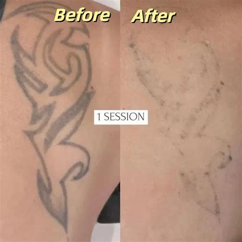 Laser Tattoo Removal Before Amp After