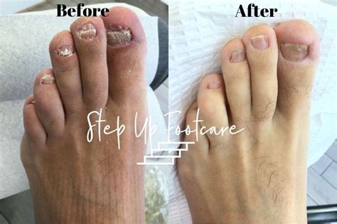 Laser Toenail Fungus Treatment Nyc Podiatrist Nyc Downtown Step Up Footcare New York City