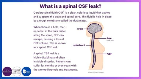 Leakweek 2023 Day One Spinal Csf Leak Foundation