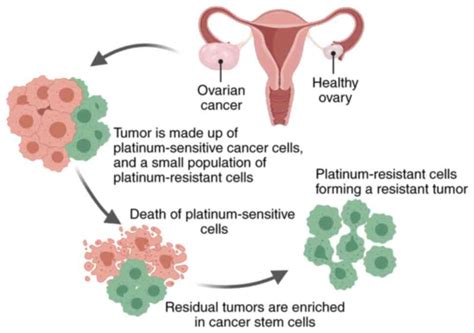 Lifesaving Ovarian Cancer Chemo Treatment Underutilized Study Finds Drug Discovery And Development