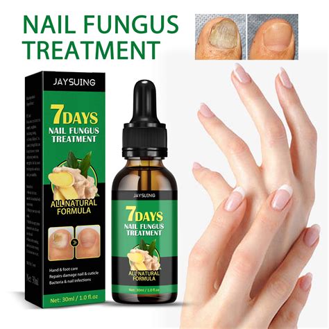 Nail Fungus Treatment Causes And Prevention Nail Fungus Treatment Causes And Prevention