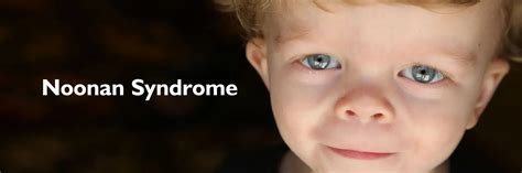 Noonan Syndrome Causes Symptoms Diagnosis And Treatment