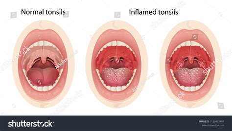 Beware: The Mistake People Make With Normal Throat Pictures