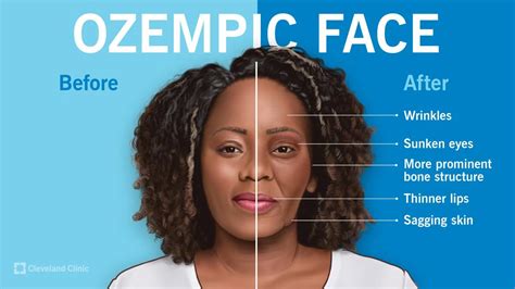 Ozempic Face What Causes It And How To Prevent It