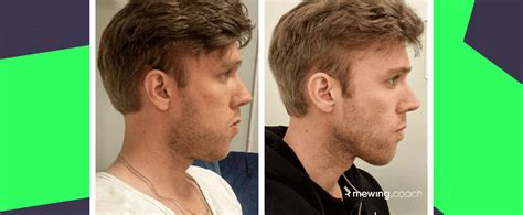 Common Mistakes About People With No Upper Jaw And How To Avoid Them