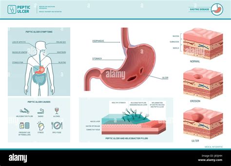 Peptic Ulcer And Helicobacter Pylori Infographic Vector Illustration