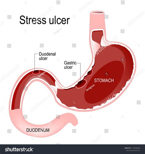 Peptic Ulcer Gastric Duodenal Stress Ulcers Ppts Pptx