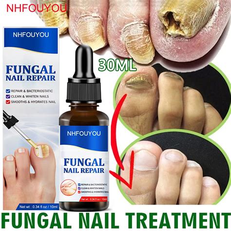 Pin On Fungal Nail Treatment