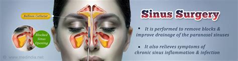 Sinus Surgery Types Procedure Recovery