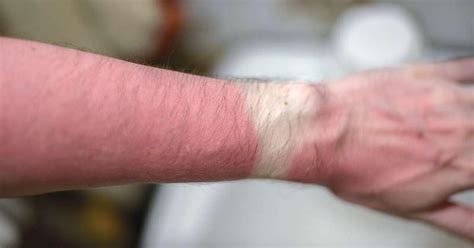 Skin Musculoskeletal Health Essential For Truck Drivers Tt Skin Musculoskeletal Health Essential For Truck Drivers Tt