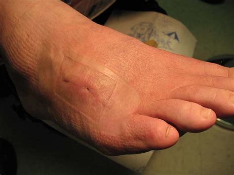 Stingray Sting Foot Stingray Sting Foot