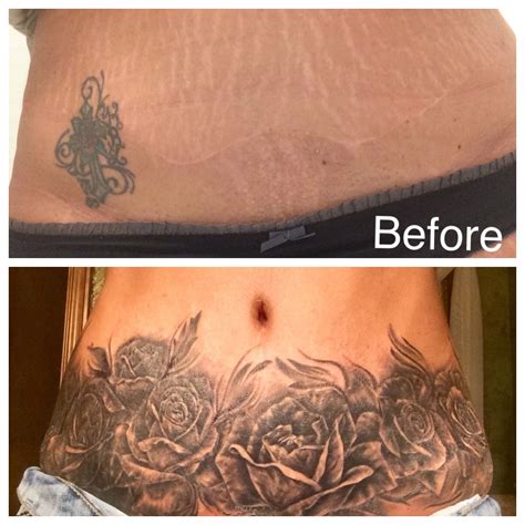 Tattooing Over Stretch Marks Before And After