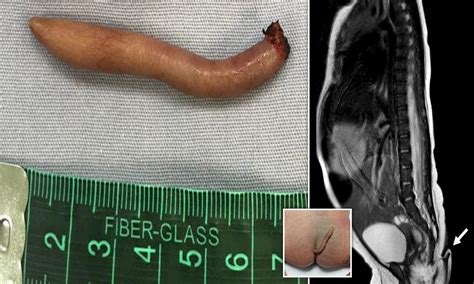 The Girl Born With A Tail Extremely Rare 6Cm Long Defect Is Covered In Hair And Skin Daily Mail Online