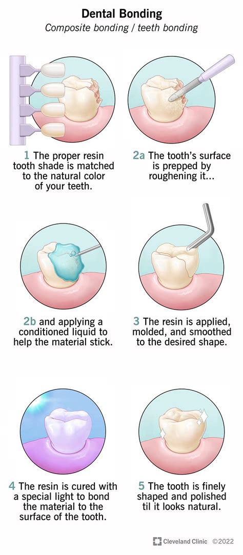 The Ultimate Guide To Dental Bonding Things You Should Know The Ultimate Guide To Dental Bonding Things You Should Know