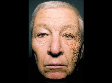 Trucker Accumulates Skin Damage On Left Side Of His Face After 28 Years On The Road Cbs News Trucker Accumulates Skin Damage On Left Side Of His Face After 28 Years On The Road Cbs News