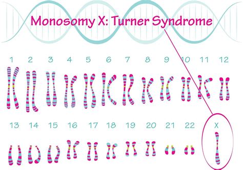 Turner Syndrome Monosomy X Turner Syndrome Monosomy X