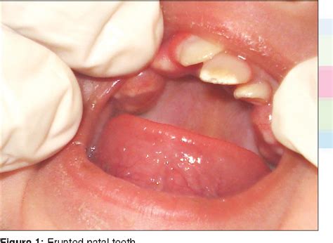 Twin Girls Born With Fully Formed Bottom Teeth Kidspot