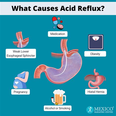 What Causes Acid Reflux Click2pharmacy