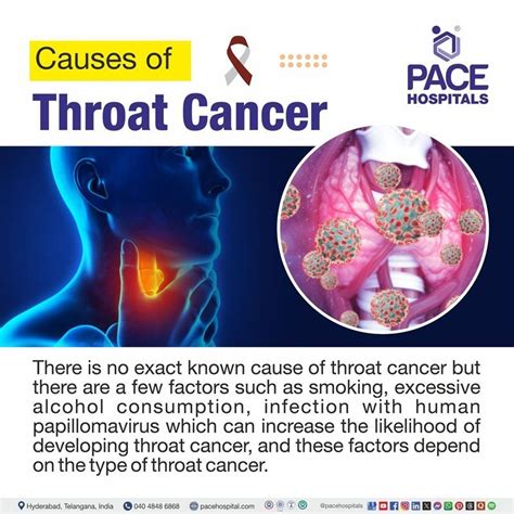 What Causes Throat Cancer