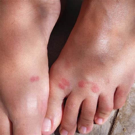 What Does A West Nile Virus Mosquito Bite Look Like What Does A West Nile Virus Mosquito Bite Look Like