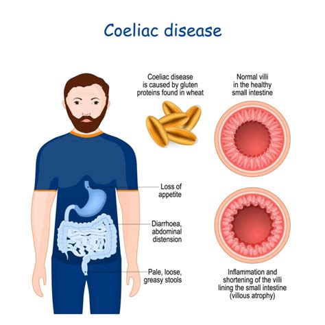 What Is A Coeliac Disease