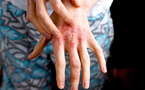 When Scratching That Itch Is The Worse Thing You Can Do Fmt