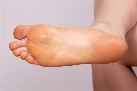 Busting The Myth That Yellow Soles Of Feet Signal Illness